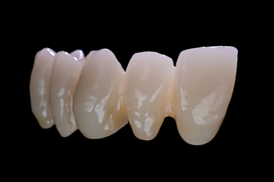 Multi Translucent PLUS – exemplu de lucrare pritidenta