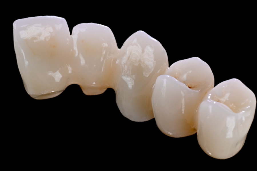 Multi Translucent PLUS – exemplu de lucrare pritidenta