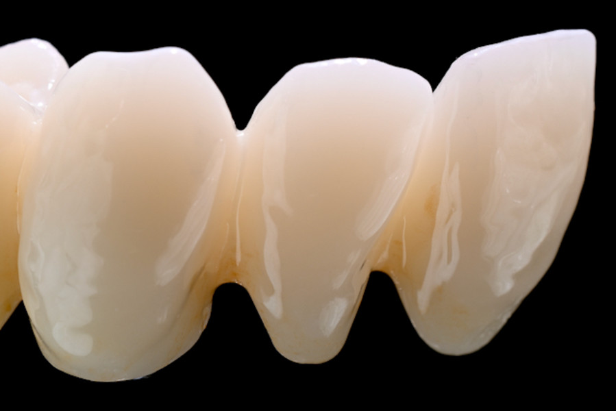 Multi Translucent PLUS – exemplu de lucrare pritidenta