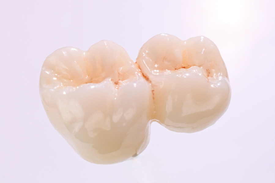 Multi Translucent PLUS – exemplu de lucrare pritidenta