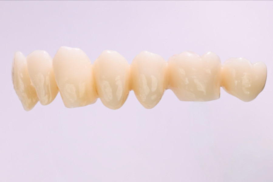 Multi Translucent PLUS – exemplu de lucrare pritidenta