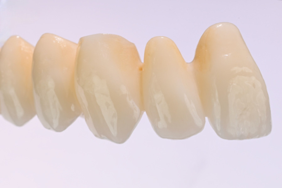 Multi Translucent PLUS – exemplu de lucrare pritidenta